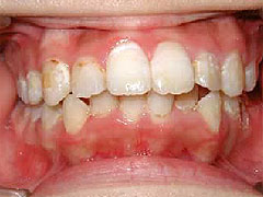 初期の虫歯(C1)