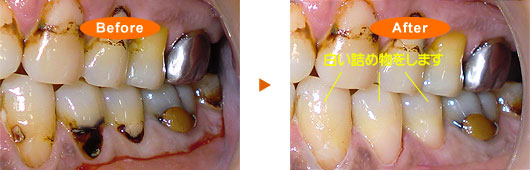 中期の虫歯(C2)(前歯部)