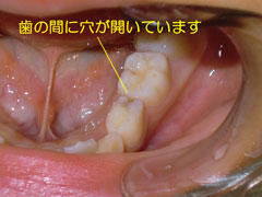 中期の虫歯(C2)(臼歯部)