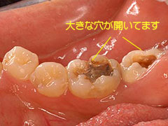 後期の虫歯(C3)