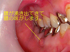 歯ぐきが腫れる(顎の骨の中に膿がたまっている)